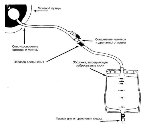 III. Завершение процедуры. 9. Убедиться, что трубка катетера приклеена пластырем к бедру и не натянута - student2.ru