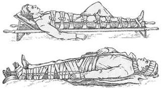 Иммобилизация нижней конечности - student2.ru
