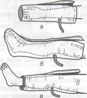 Иммобилизация нижней конечности - student2.ru