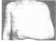 иммобилизация при вывихах (подвывихах) суставов - student2.ru