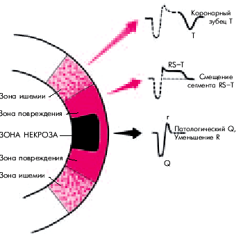 инфаркт миокарда с зубцом q - student2.ru