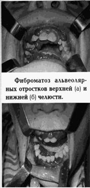 исходящие из мягких тканей полости рта и ротоглотки - student2.ru