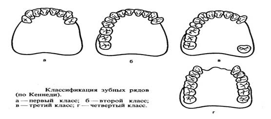 IV тип - неравномерная атрофия альвеолярного отростка, т.е. сочетает в себе различные признаки первого, второго и третьего типов. - student2.ru