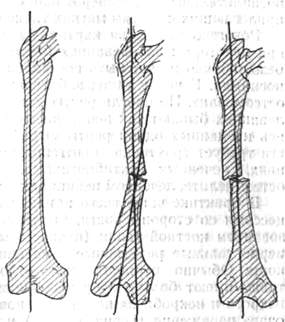 Изменения внешней формы костей и суставов - student2.ru
