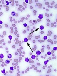 Изучение мазка крови при хроническом миелолейкозе. - student2.ru