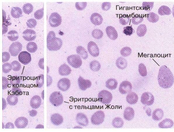 Изучение мазков крови при острой постгеморрагической анемии. - student2.ru