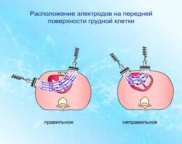 Воздуховод (оротрахеальный, назотрахеальный) - student2.ru