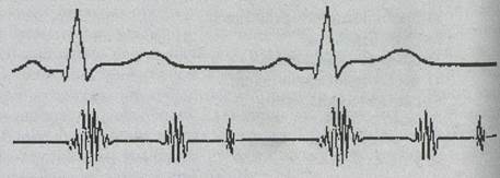 Как называются патологические ритмы, изображенные на ФКГ? - student2.ru