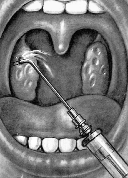 Каковы консервативные методы лечения хронического тонзиллита - student2.ru
